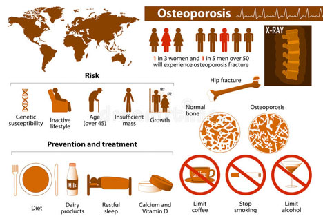 Osteoperosis infograph