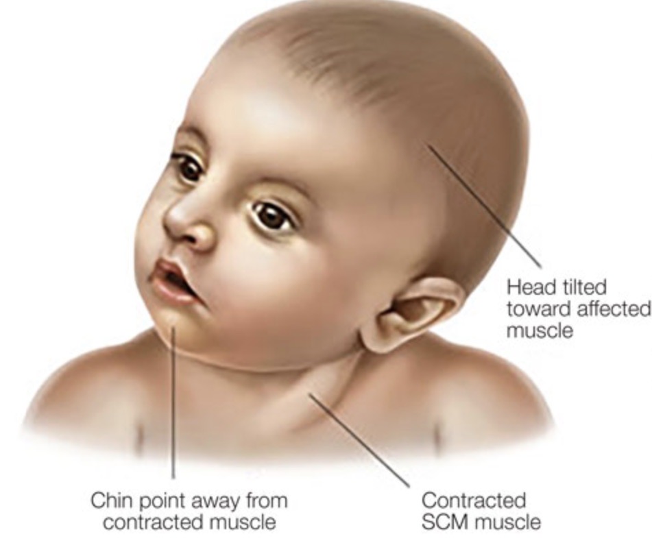 lymph nodes on back of head baby