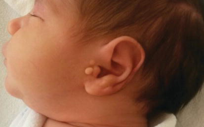 Newborn Care - Ears - Philadelphia FIGHT